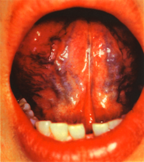 舌の写真.bmp